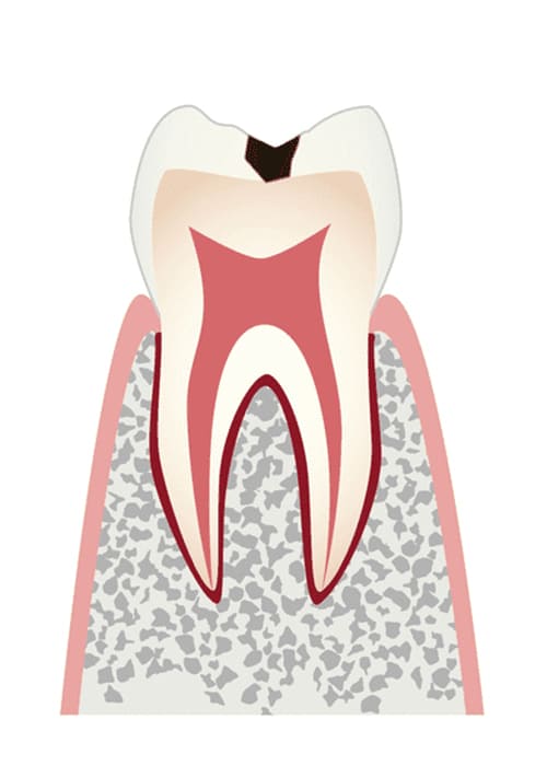 C1 エナメル質に小さな穴が空いたむし歯