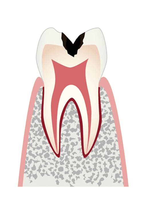 C2 歯の内部（象牙質）まで進行したむし歯